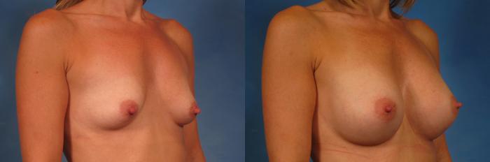 Before & After Silicone Breast Implants Case 279 View #3 View in Naples and Ft. Myers, FL
