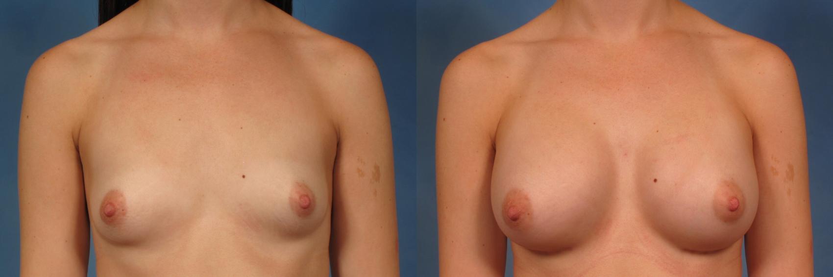 Before & After Silicone Breast Implants Case 286 View #1 View in Naples and Ft. Myers, FL