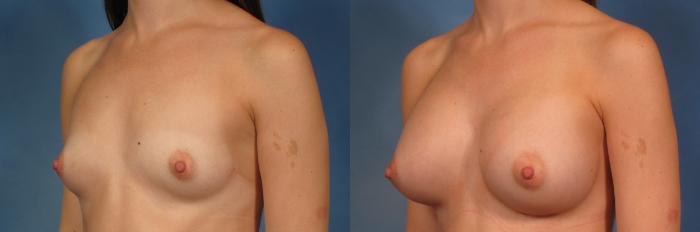 Before & After Silicone Breast Implants Case 286 View #2 View in Naples and Ft. Myers, FL
