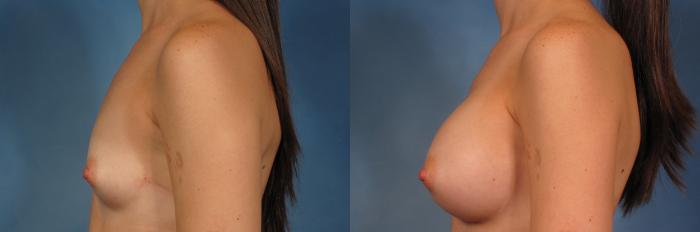 Before & After Silicone Breast Implants Case 286 View #3 View in Naples and Ft. Myers, FL