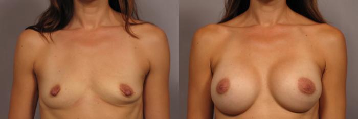 Before & After Silicone Breast Implants Case 321 View #1 View in Naples and Ft. Myers, FL