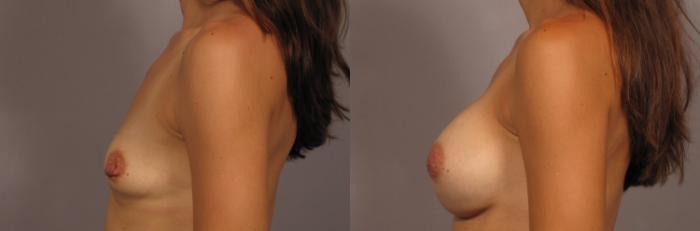 Before & After Silicone Breast Implants Case 321 View #3 View in Naples and Ft. Myers, FL