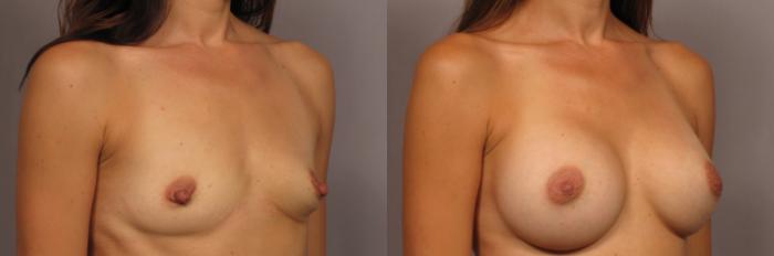Before & After Silicone Breast Implants Case 321 View #4 View in Naples and Ft. Myers, FL