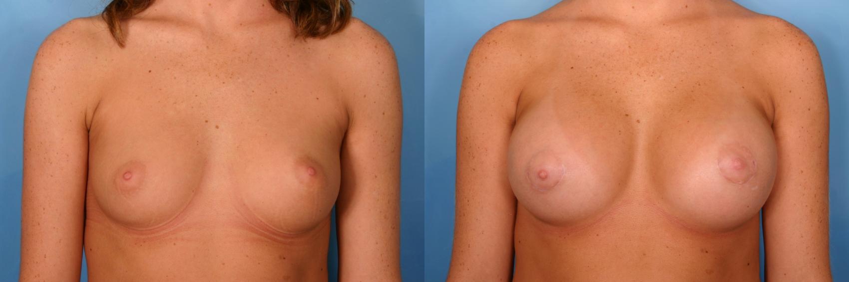 Before & After Silicone Breast Implants Case 72 View #1 View in Naples and Ft. Myers, FL