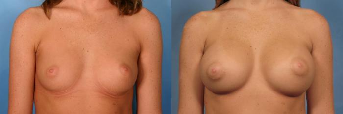 Before & After Silicone Breast Implants Case 72 View #4 View in Naples and Ft. Myers, FL