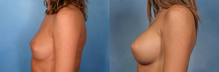 Before & After Silicone Breast Implants Case 72 View #5 View in Naples and Ft. Myers, FL