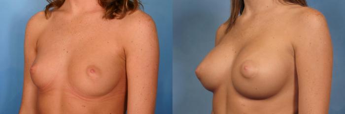 Before & After Silicone Breast Implants Case 72 View #6 View in Naples and Ft. Myers, FL