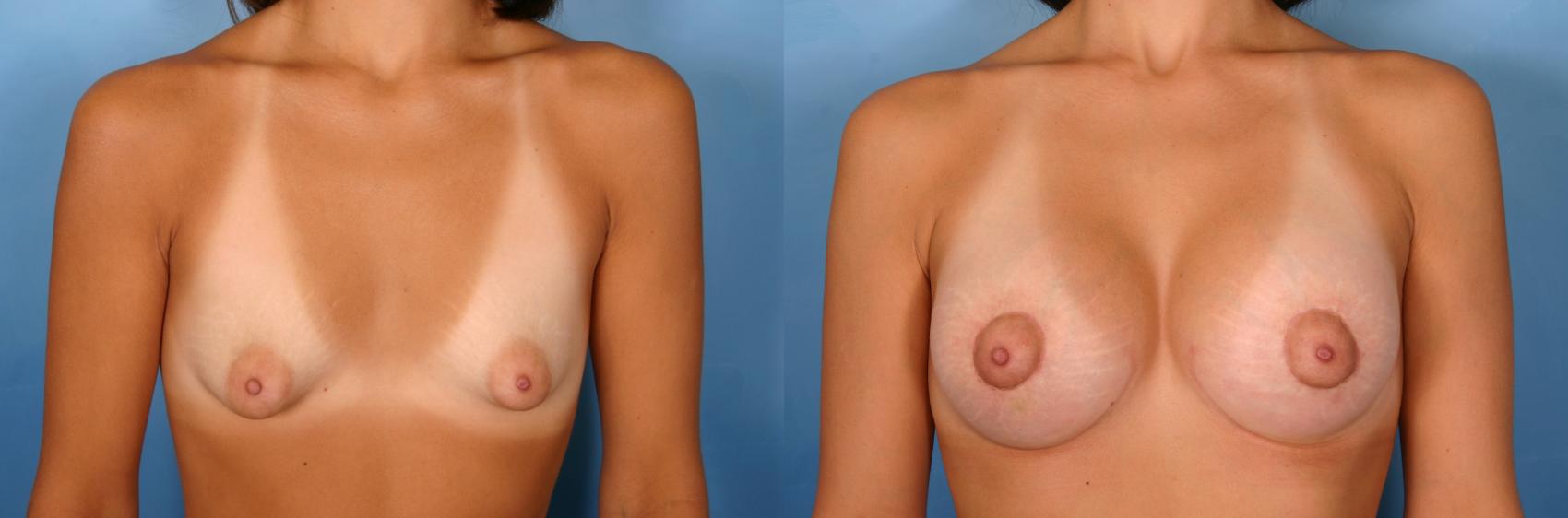 Before & After Silicone Breast Implants Case 74 View #1 View in Naples and Ft. Myers, FL