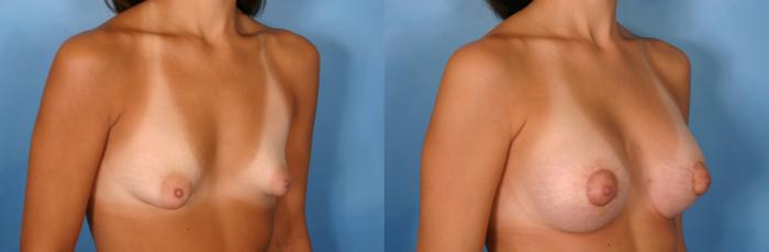 Before & After Silicone Breast Implants Case 74 View #2 View in Naples and Ft. Myers, FL