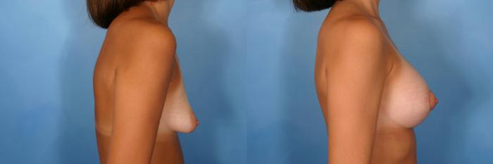 Before & After Silicone Breast Implants Case 74 View #3 View in Naples and Ft. Myers, FL
