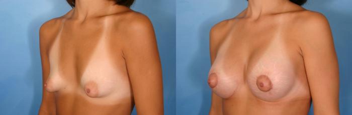 Before & After Silicone Breast Implants Case 74 View #4 View in Naples and Ft. Myers, FL