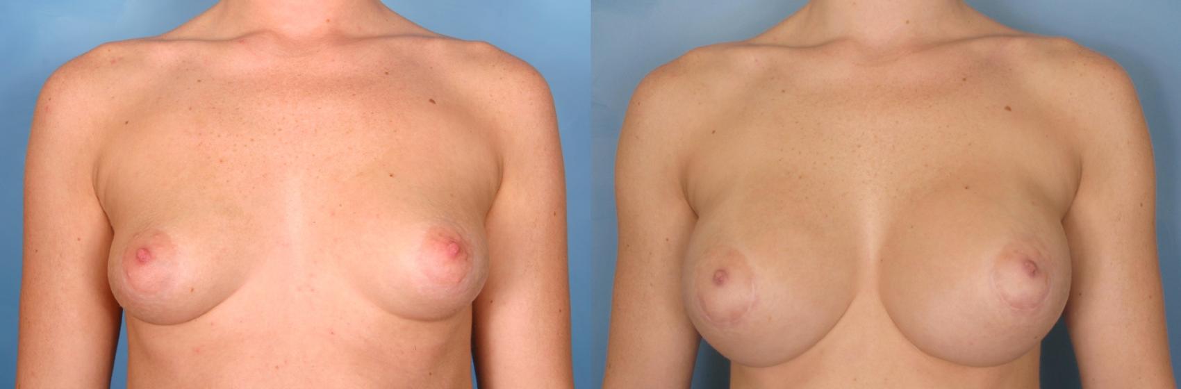 Before & After Silicone Breast Implants Case 75 View #4 View in Naples and Ft. Myers, FL