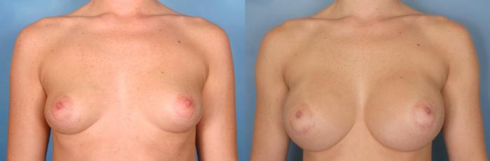 Before & After Silicone Breast Implants Case 75 View #4 View in Naples and Ft. Myers, FL