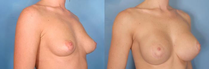 Before & After Silicone Breast Implants Case 75 View #5 View in Naples and Ft. Myers, FL