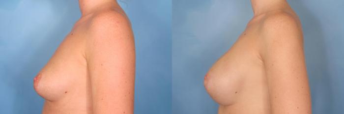 Before & After Silicone Breast Implants Case 75 View #6 View in Naples and Ft. Myers, FL