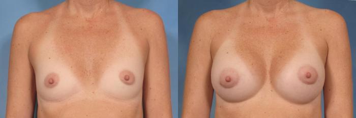 Before & After Silicone Breast Implants Case 92 View #1 View in Naples and Ft. Myers, FL