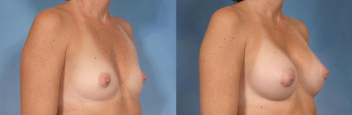 Before & After Silicone Breast Implants Case 92 View #2 View in Naples and Ft. Myers, FL