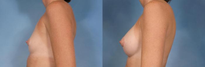 Before & After Silicone Breast Implants Case 92 View #3 View in Naples and Ft. Myers, FL