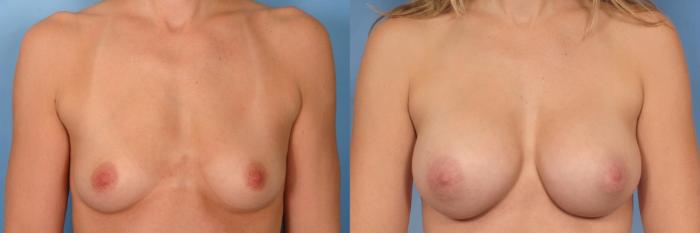 Before & After Silicone Breast Implants Case 94 View #1 View in Naples and Ft. Myers, FL