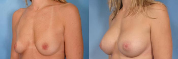 Before & After Silicone Breast Implants Case 94 View #2 View in Naples and Ft. Myers, FL
