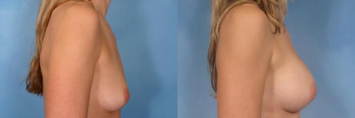 Before & After Silicone Breast Implants Case 94 View #3 View in Naples and Ft. Myers, FL