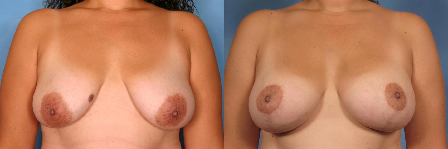 Before & After Silicone Breast Implants Case 99 View #1 View in Naples and Ft. Myers, FL