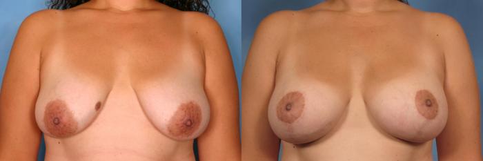 Before & After Silicone Breast Implants Case 99 View #1 View in Naples and Ft. Myers, FL