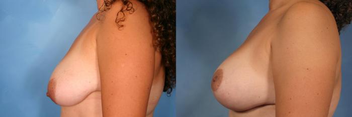Before & After Silicone Breast Implants Case 99 View #3 View in Naples and Ft. Myers, FL