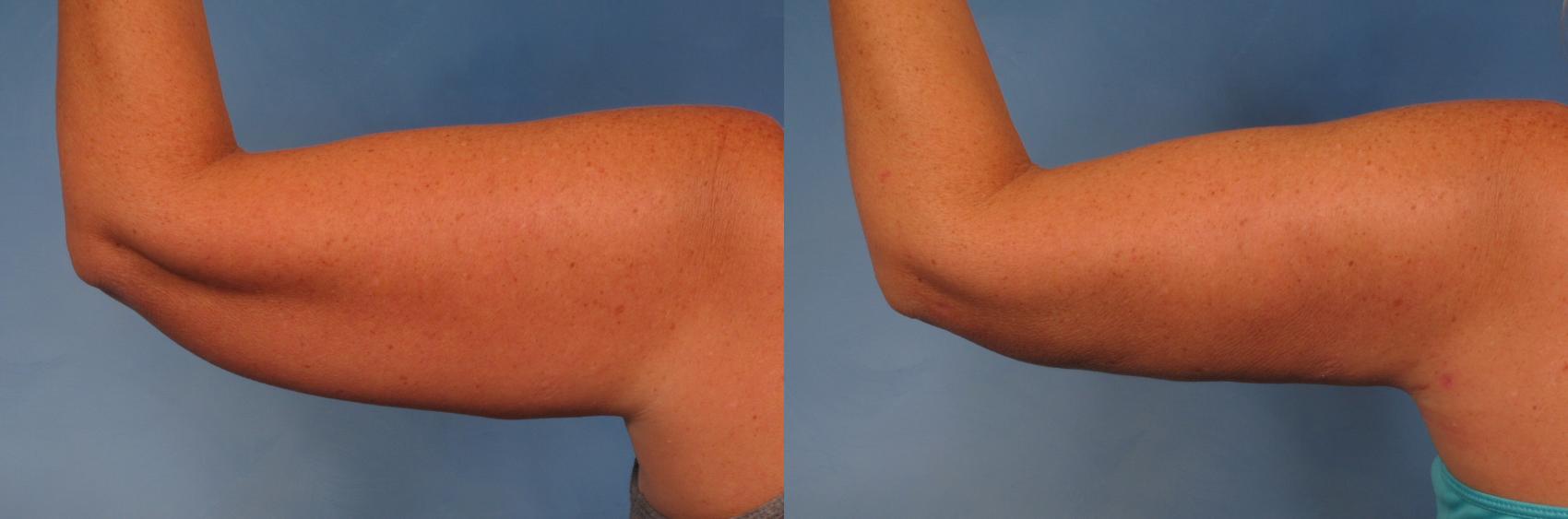 Before & After Smart Lipo Case 263 View #1 View in Naples and Ft. Myers, FL