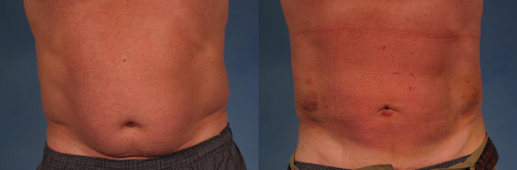 Before & After Smart Lipo Case 269 View #1 View in Naples and Ft. Myers, FL