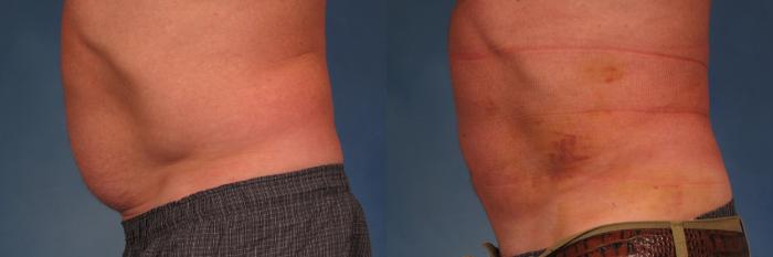 Before & After Smart Lipo Case 269 View #2 View in Naples and Ft. Myers, FL