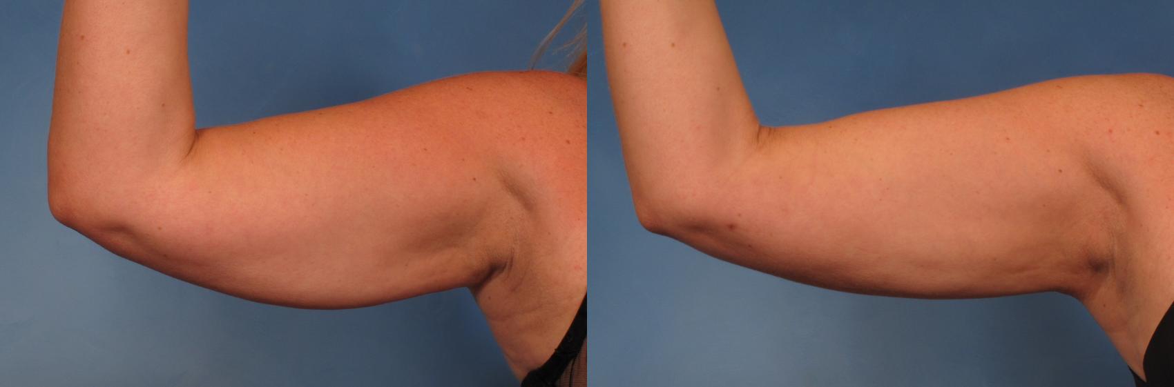 Before & After Smart Lipo Case 270 View #1 View in Naples and Ft. Myers, FL