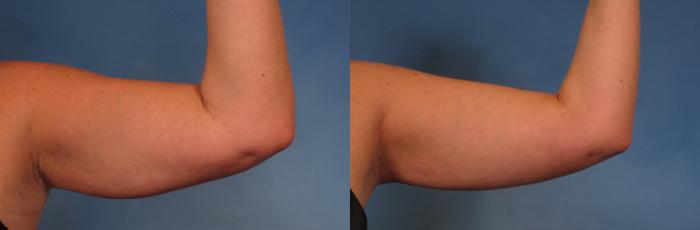 Before & After Smart Lipo Case 270 View #2 View in Naples and Ft. Myers, FL