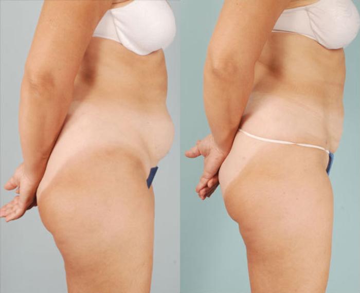 Before & After Smart Lipo Case 291 View #1 View in Naples and Ft. Myers, FL
