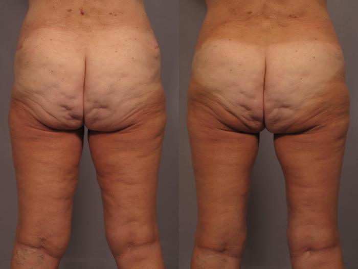 Thigh Lift Before and 1 Year After, Posterior
