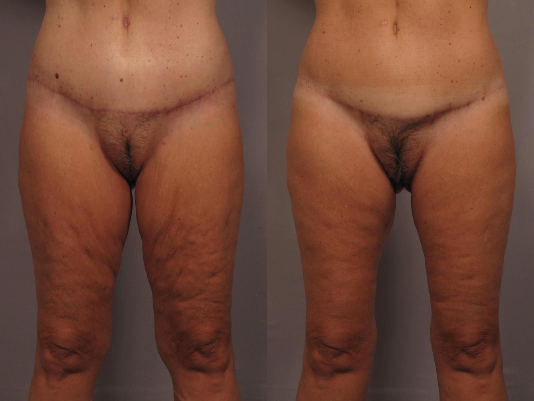 Thigh Lift Before and After, Front View