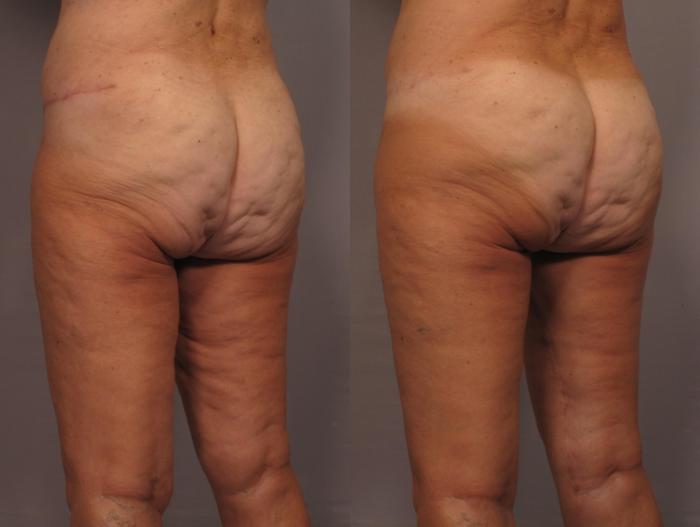 Thigh Lift Before and 1 Year After, Left Posterior Oblique