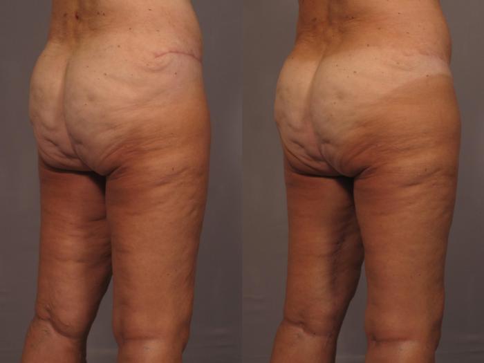 Thigh Lift Before and 1 Year After, Right Posterior Oblique