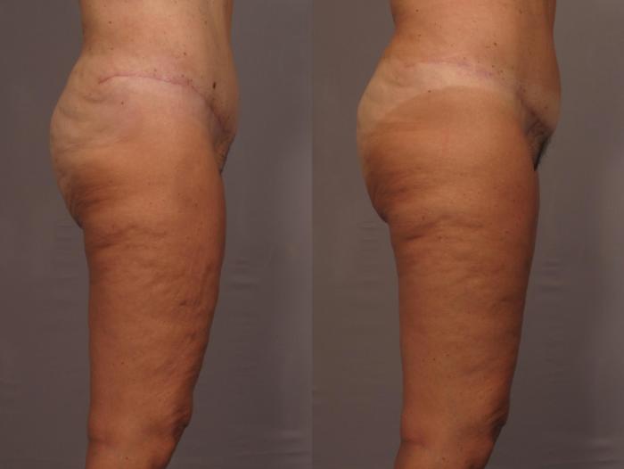 Thigh Lift Before and 1 Year After, Right Side