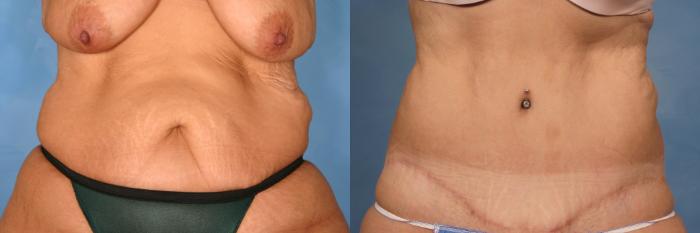Before & After Tummy Tuck Case 112 View #1 View in Naples and Ft. Myers, FL