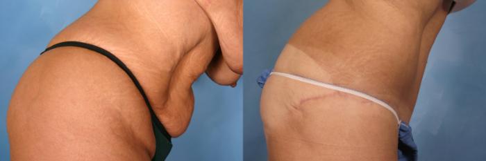 Before & After Tummy Tuck Case 112 View #2 View in Naples and Ft. Myers, FL