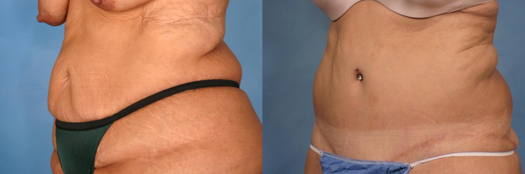 how much is a tummy tuck