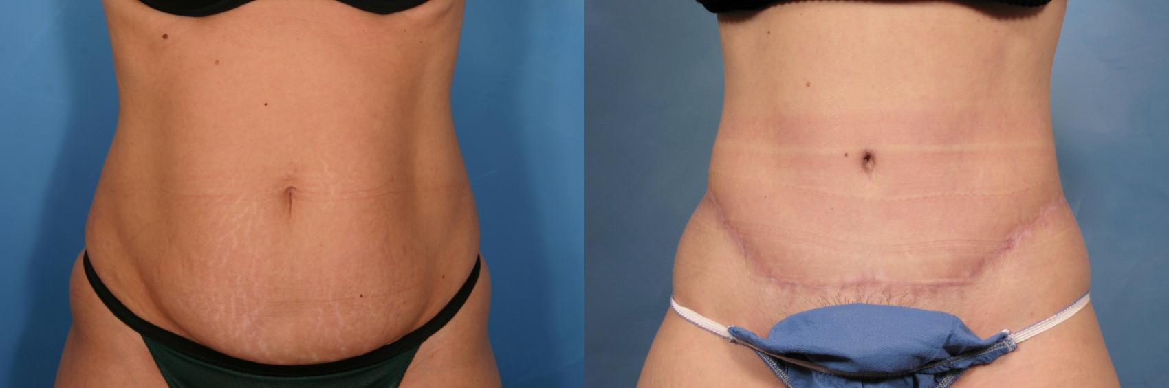 Before & After Tummy Tuck Case 113 View #1 View in Naples and Ft. Myers, FL