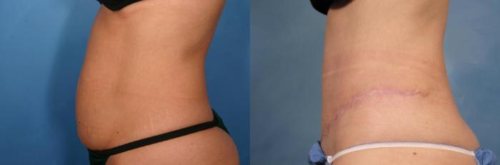 Before & After Tummy Tuck Case 113 View #3 View in Naples and Ft. Myers, FL