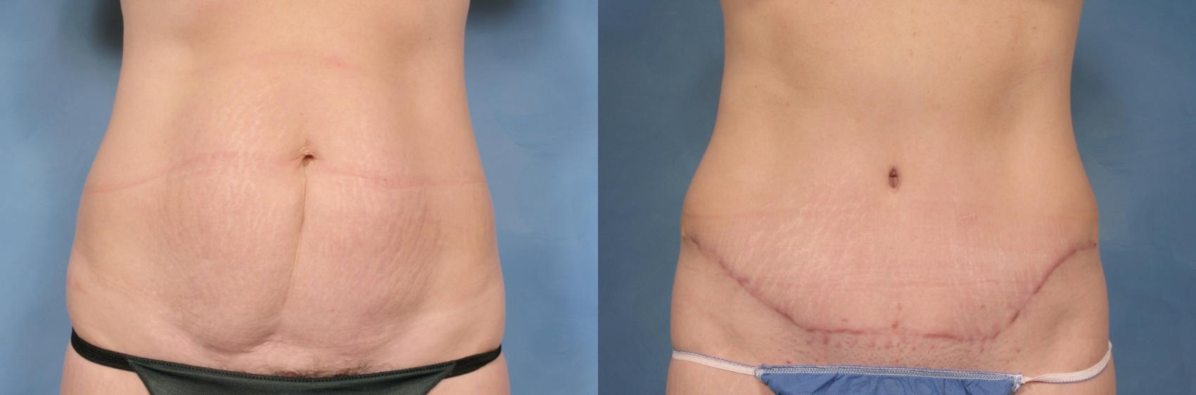 Before & After Tummy Tuck Case 114 View #1 View in Naples and Ft. Myers, FL
