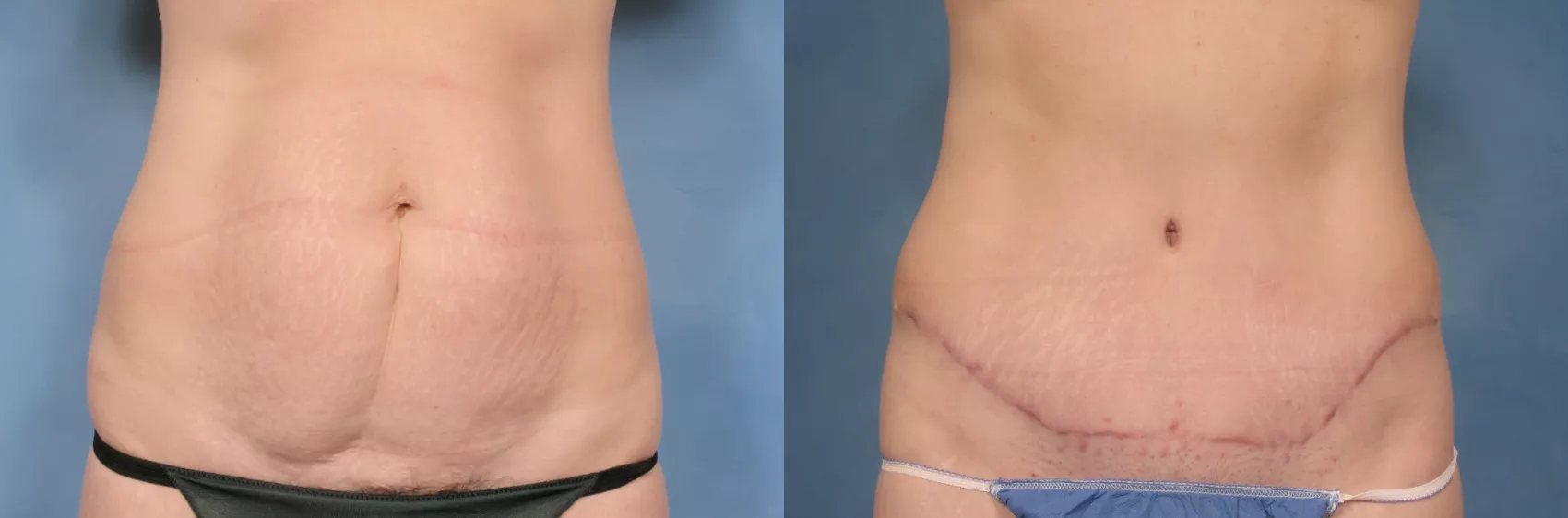 Tummy Tuck Before and After Pictures Miami, Aventura, FL