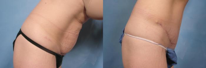 Before & After Tummy Tuck Case 114 View #2 View in Naples and Ft. Myers, FL