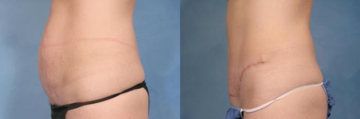 Before & After Tummy Tuck Case 114 View #3 View in Naples and Ft. Myers, FL