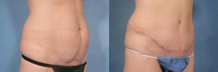 Before & After Tummy Tuck Case 114 View #4 View in Naples and Ft. Myers, FL