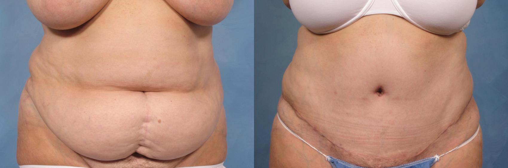 Before & After Tummy Tuck Case 115 View #1 View in Naples and Ft. Myers, FL